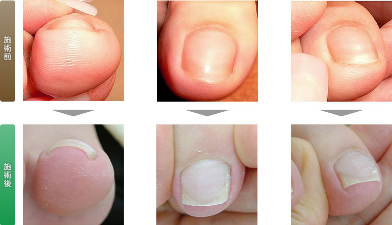 重度な巻き爪の補正施術例４（陥入爪型 ２）